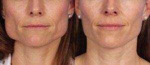How Orthognathic Surgery Can Improve Breathing, Speech, and Confidence? 