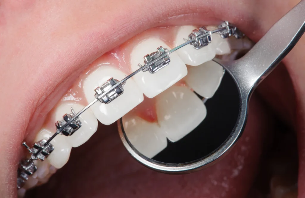 Traditional Braces vs Clear Braces: Which Is Right for You?
