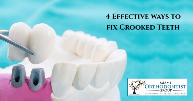 4 Effective ways to fix Crooked Teeth