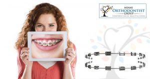 How To Prevent Tooth Decay While Wearing Braces