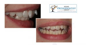 6 Common Bite Alignment Problems