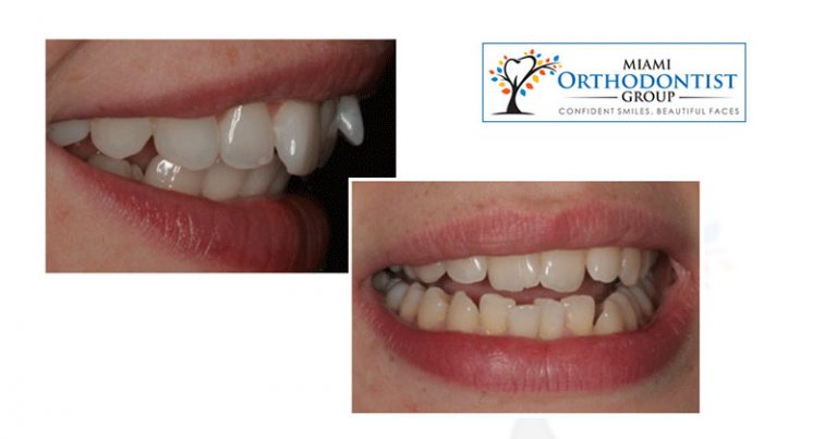 6 Common Bite Alignment Problems