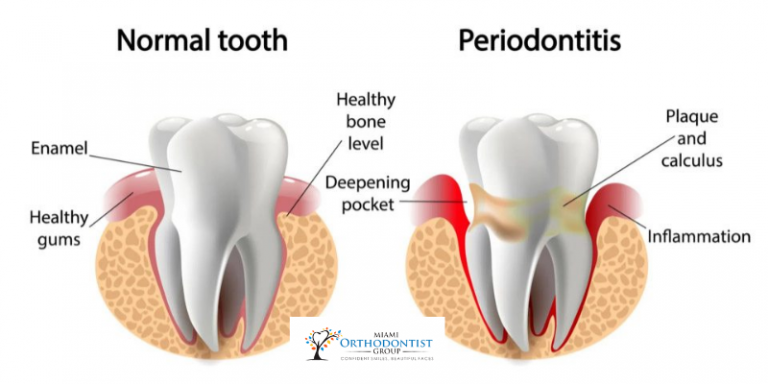What Are Periodontal Disease Symptoms