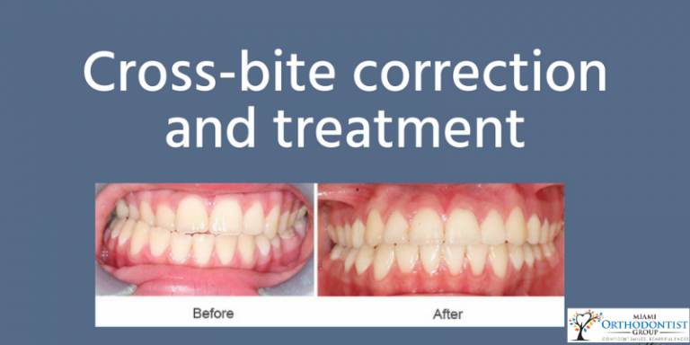 What Is A Crossbite_ Signs, Effects, and Treatment