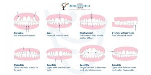 bad bite treatment in Doral