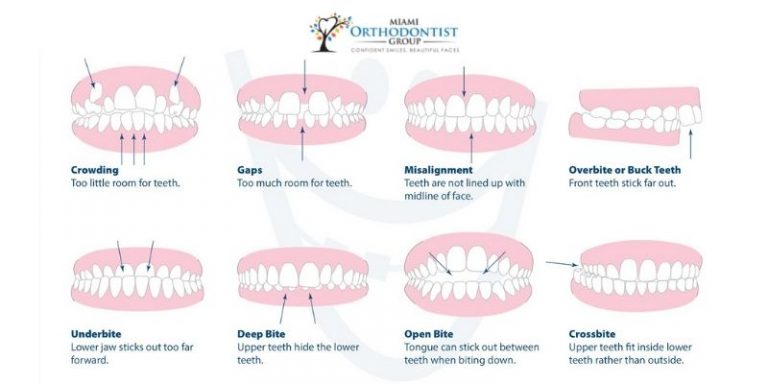 bad bite treatment in Doral