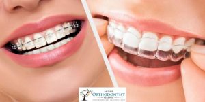 Invisalign or braces
