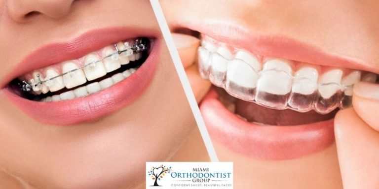 Invisalign or braces