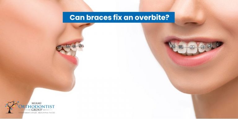 fix an overbite