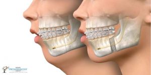Orthognathic Surgery