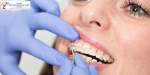 what is covered in bite alignment treatment