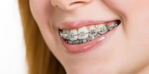 how long will your retainers last