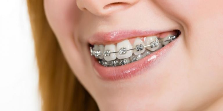 how long will your retainers last