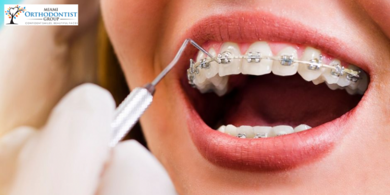 Retainers After Braces_ Use and Cleaning Guidelines