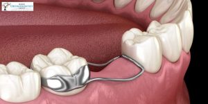 Role of Space Maintainers in Oral Health Preservation