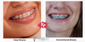 Clear Braces vs. Conventional Braces