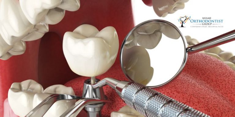 Dental Implants