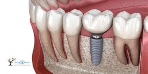 Dental implants