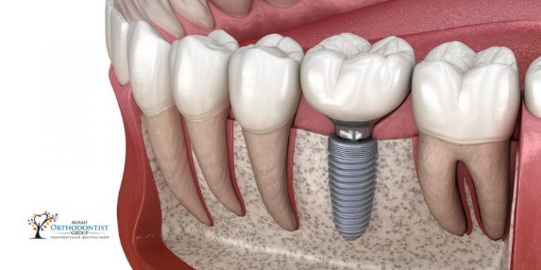 Dental implants