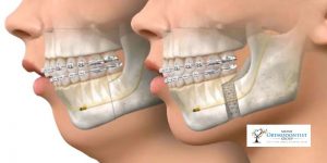 Orthognathic Surgery