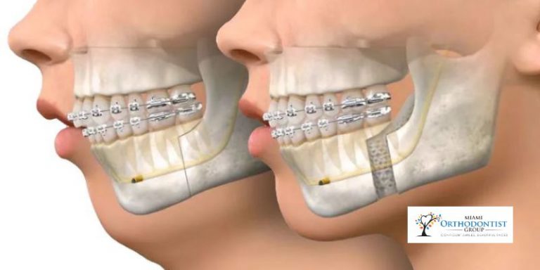 Orthognathic Surgery