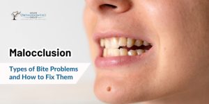 Malocclusion