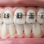 braces over aligners