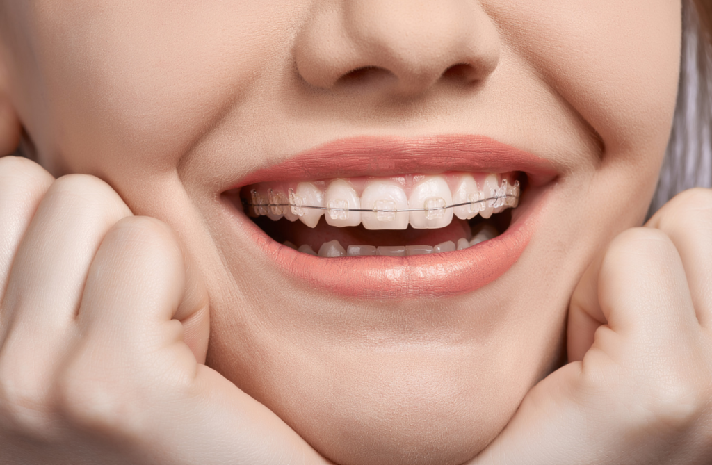 How to Make Braces More Affordable in Miami
