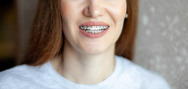 Clear Aligners vs Traditional Braces: Which Works Faster?